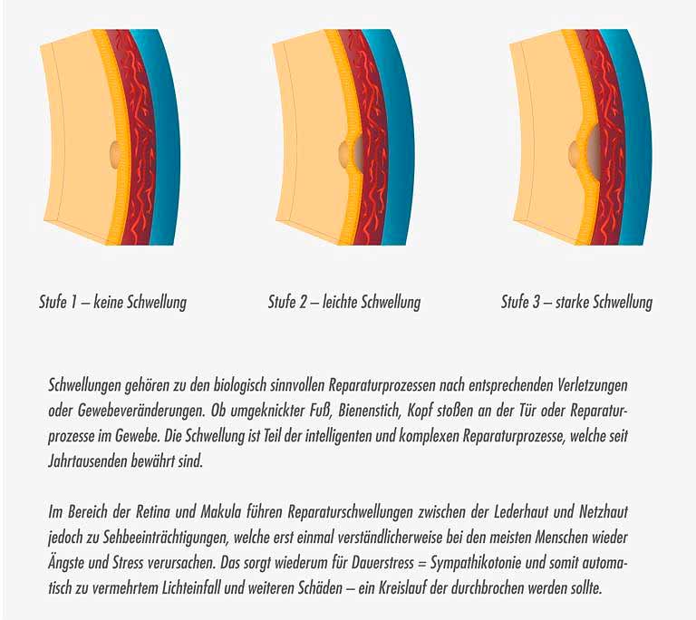 Altersbedingte_Makuladegeneration_AMD_Schwellung_der_Makula